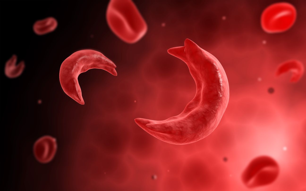 Sickle Cell Disease: What You Need to Know