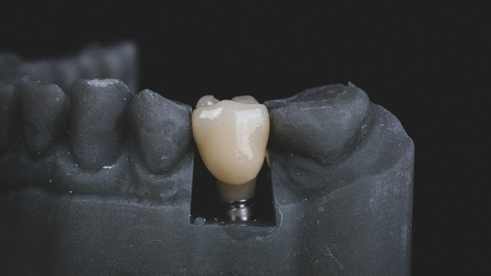 Dental Implants: The Future of Smile Restoration